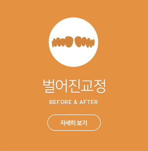 벌어진교정