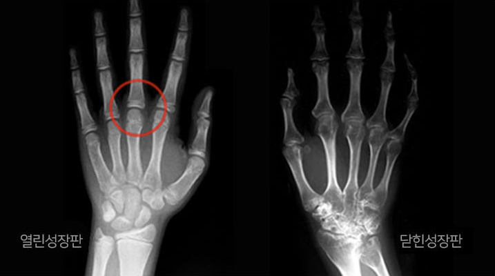손가락 X-ray