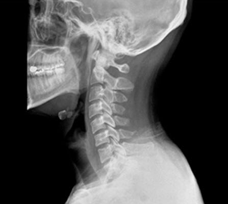 두경부 X-ray